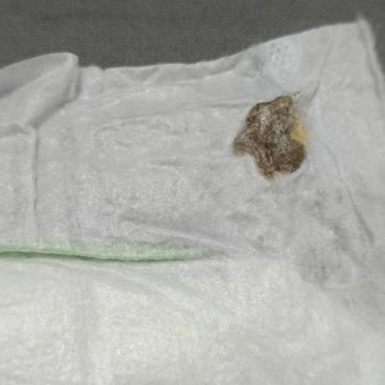 Bebek Bezinde Yabancı Cisim Şoku: Sağlık Riski Ve Güven Kaybı