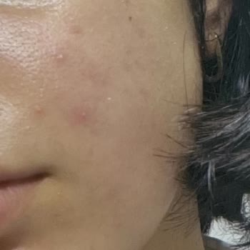 Frudia Yüz Yıkama Jeli Yan Etki Yaptı