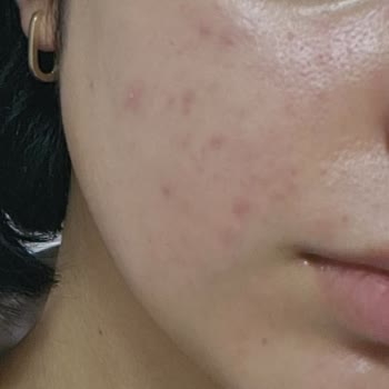 Frudia Yüz Yıkama Jeli Yan Etki Yaptı