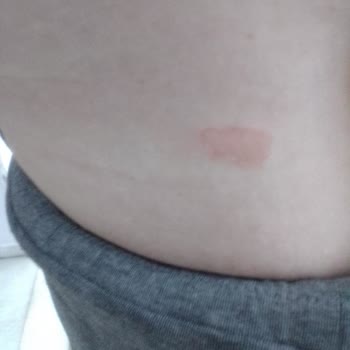 Sıcak Su Torbası Delindi, Yanık Ve Mağduriyet Yaşadım; Amazon'dan Yetersiz Destek