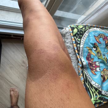 Lazer Epilasyon Sonrası Yanık Ve Yetersiz Destek Nedeniyle Mağduriyet