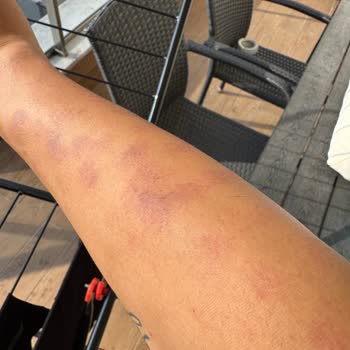 Lazer Epilasyon Sonrası Yanık Ve Yetersiz Destek Nedeniyle Mağduriyet