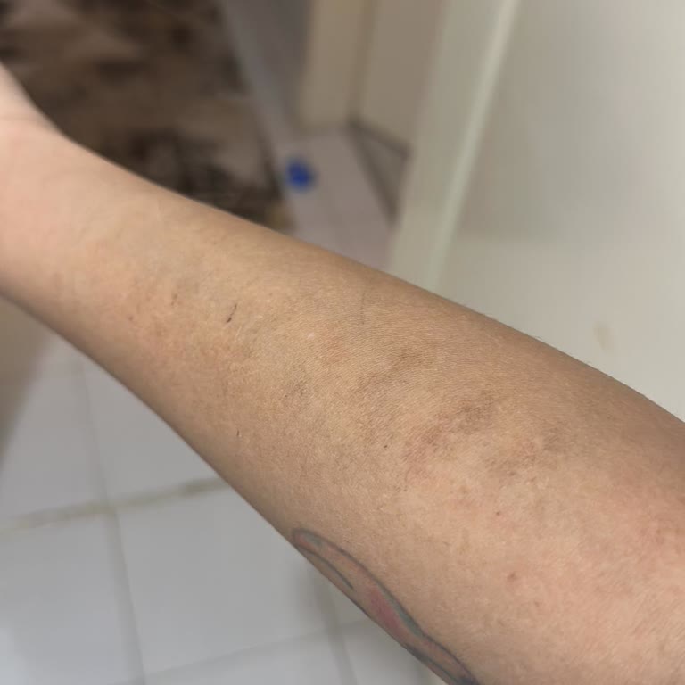 Lazer Epilasyon Sonuçsuz Kaldı, Yanık İzleri Ve İlgisizlik Yaşadım