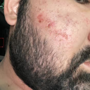 Buz Lazer Sonrası Yüzümde Yanık Oluştu Mağduriyetim Giderilmedi