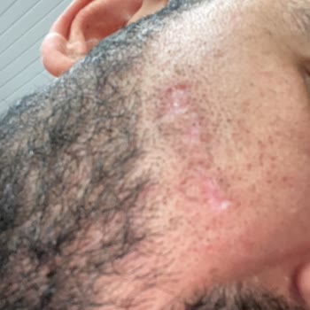 Buz Lazer Sonrası Yüzümde Yanık Oluştu Mağduriyetim Giderilmedi