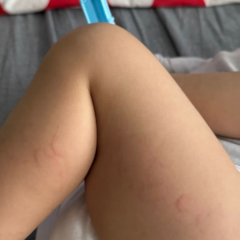 Çocukta Alerjik Reaksiyona Sebep Olan Çikolata