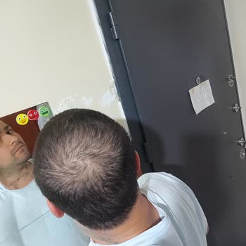 Adem Köse Saç Ekiminde İsteklerim Dikkate Alınmadı ve Sonuç Beklentimi Karşılamadı