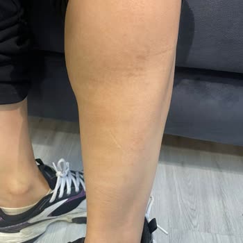 Lazer Epilasyon Sonrası Kalıcı Yanık Lekeleri Ve Çözüm Sunulmayan Mağduriyet