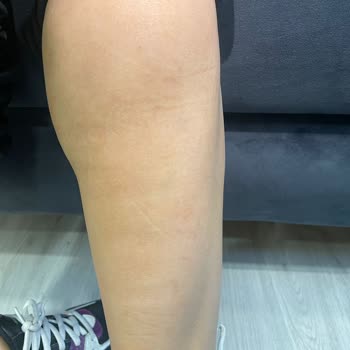 Lazer Epilasyon Sonrası Kalıcı Yanık Lekeleri Ve Çözüm Sunulmayan Mağduriyet