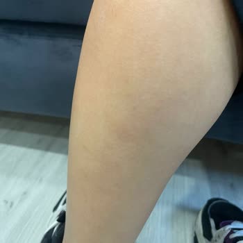 Lazer Epilasyon Sonrası Kalıcı Yanık Lekeleri Ve Çözüm Sunulmayan Mağduriyet