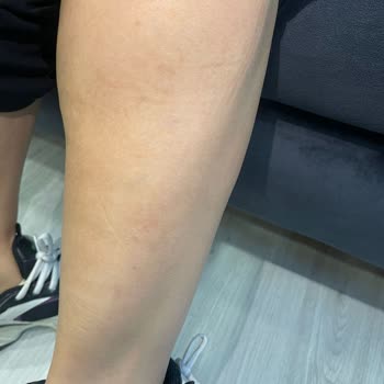 Lazer Epilasyon Sonrası Kalıcı Yanık Lekeleri Ve Çözüm Sunulmayan Mağduriyet