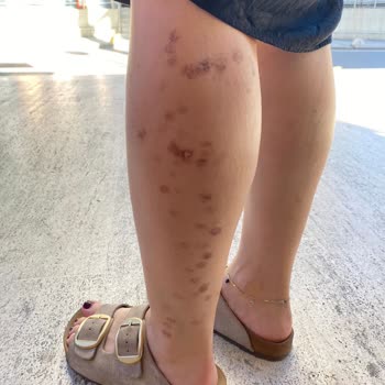 Lazer Epilasyon Sonrası Kalıcı Yanık Lekeleri Ve Çözüm Sunulmayan Mağduriyet