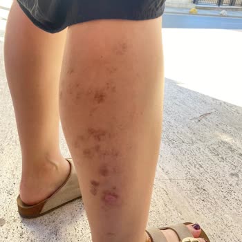 Lazer Epilasyon Sonrası Kalıcı Yanık Lekeleri Ve Çözüm Sunulmayan Mağduriyet