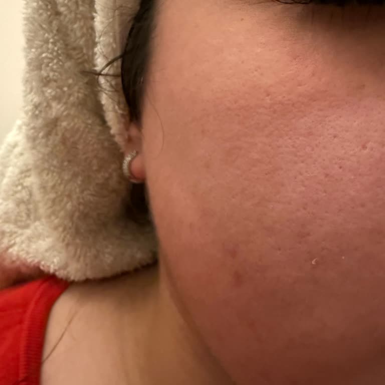 Sebamed Şampuan İlk Kullanımda Ciltte Yanma Ve Kızarıklık Yaptı