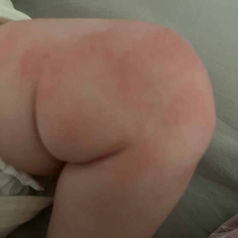 Mustela Bebek Şampuanı Sonrası Kaşıntı Ve Kızarıklık Sorunu