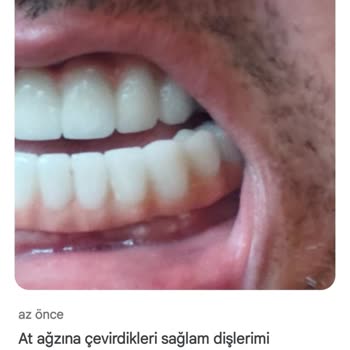 Özel İşçievleri Diş Sağlığı 11 Aydır Süren Başarısız Diş Tedavisi Ve Kalıcı Çözüm Alamama