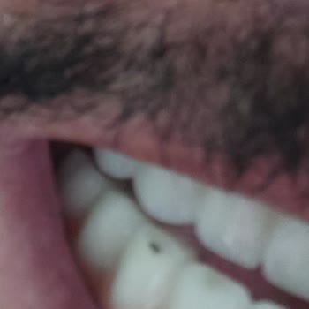 Özel İşçievleri Diş Sağlığı 11 Aydır Süren Başarısız Diş Tedavisi Ve Kalıcı Çözüm Alamama