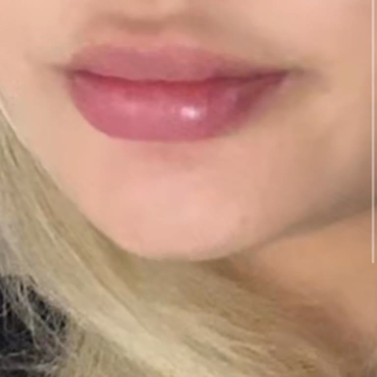 Dudak Dolgusu Sonrası Mağduriyet Ve Klinik İlgisizliği