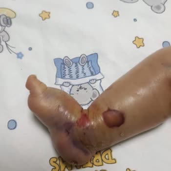 Yoğun Bakımda İhmal Ve Bilgi Eksikliği Oğlumun Hayatına Mal Oldu