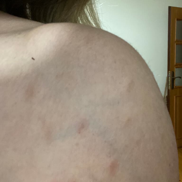 Duru Body Scrub Kullanımı Sonrası Ciddi Alerjik Reaksiyon Ve Hastanede Tedavi