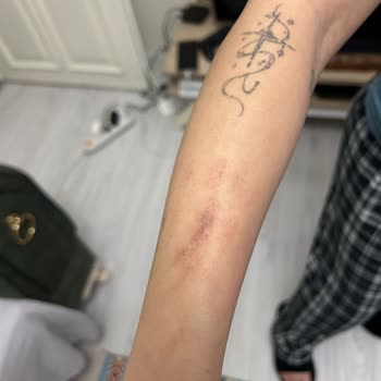 Yanlış Lazer Cihazı Kullanımıyla Oluşan Ciddi Yanıklar Ve İlgisiz Yaklaşım