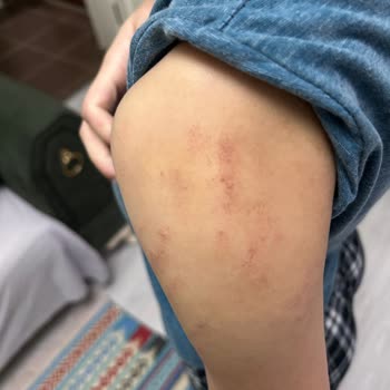 Yanlış Lazer Cihazı Kullanımıyla Oluşan Ciddi Yanıklar Ve İlgisiz Yaklaşım