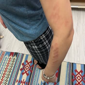 Yanlış Lazer Cihazı Kullanımıyla Oluşan Ciddi Yanıklar Ve İlgisiz Yaklaşım