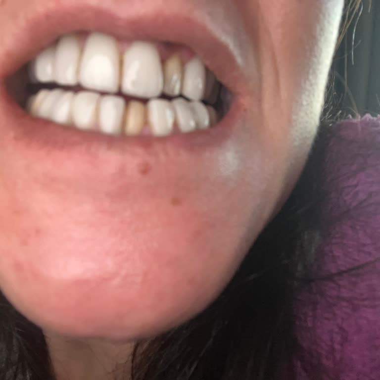 Dentflor Ağız Ve Diş Sağlığı Polikliniği Dişlerden İki Tanesi Beş Ay Sonra Düştü