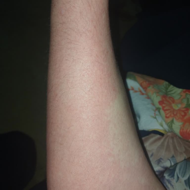 Santa Farma Krem Kullanımı Sonrası Ciltte Beklenmeyen Alerjik Reaksiyon