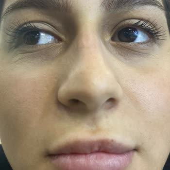 Dudak Dolgusu İşlemlerinde Sürekli Sorun Ve İlgisizlik