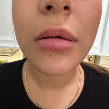 Dudak Dolgusu İşlemlerinde Sürekli Sorun Ve İlgisizlik