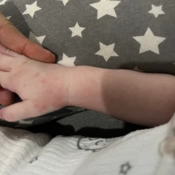 Hipp Organik Devam Sütü Bebeğimde Alerji Ve Sağlık Sorunlarına Yol Açtı