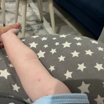 Hipp Organik Devam Sütü Bebeğimde Alerji Ve Sağlık Sorunlarına Yol Açtı