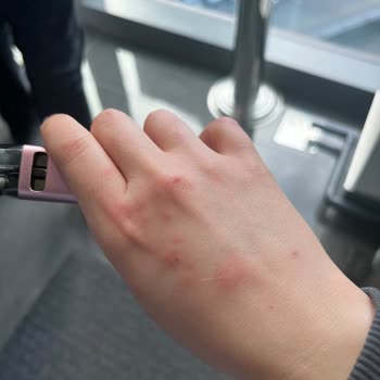 Yeni Alınan Yatak Ve Bazadan Kaynaklanan Tahta Kurusu Sorunu Ve Mağduriyet