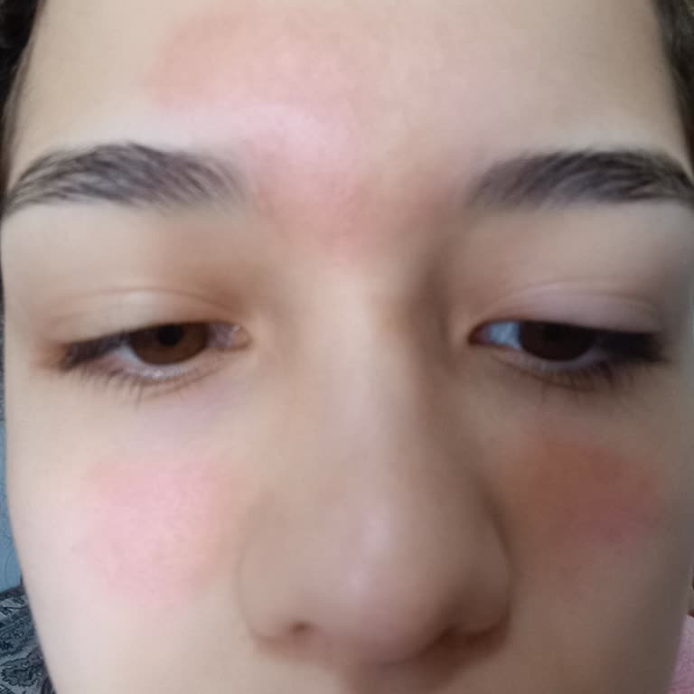 Yves Rocher Peeling Ürünü Yüzümde Yanık Ve Kaşıntıya Sebep Oldu