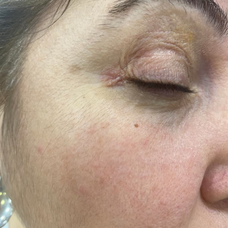 Isana Göz Kremi Cildimde Egzama Benzeri Reaksiyona Yol Açtı, İade Talep Ediyorum