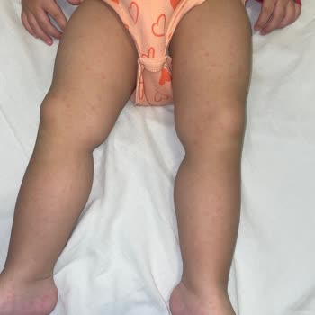 Aptamil 1 Devam Sütü Bebeğimde Pişiğe Ve Kötü Kokuya Sebep Oldu, Çözüm Sunulmadı