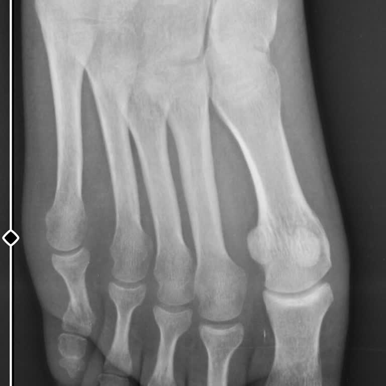 Yanlış Tedavi Sonrası Kırık Parmağımda Kalıcı Hasar Ve Yaşam Kalitemde Düşüş