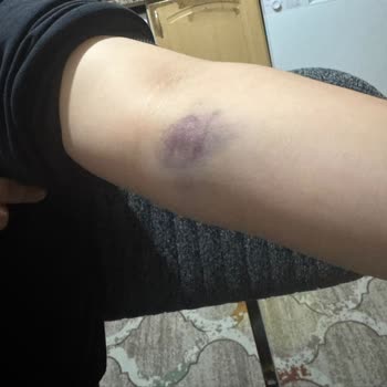 Hemşirenin Hatalı Kan Alma İşlemi Sonrası İlgisizlik Ve Azarlanma