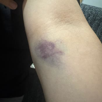 Hemşirenin Hatalı Kan Alma İşlemi Sonrası İlgisizlik Ve Azarlanma