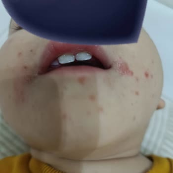 Çocuğumun İlaç Yan Etkisi Ve Yetersiz Bilgilendirme Nedeniyle Mağduriyet Yaşadık