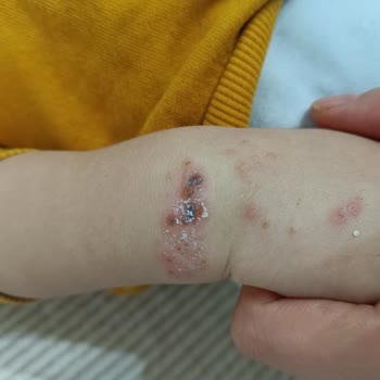 Çocuğumun İlaç Yan Etkisi Ve Yetersiz Bilgilendirme Nedeniyle Mağduriyet Yaşadık