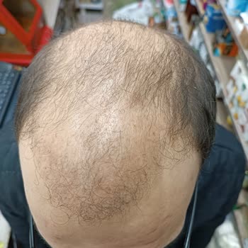 Saç Ekimi Sonrası Sonuç Alınamaması Ve Ücret İadesi Sorunu