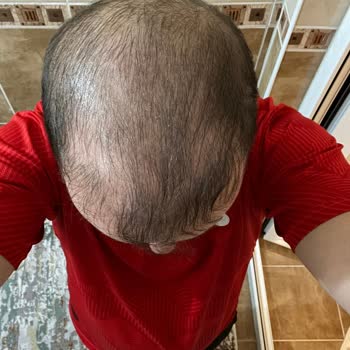 Saç Ekimi Sonrası Sonuç Alınamaması Ve Ücret İadesi Sorunu