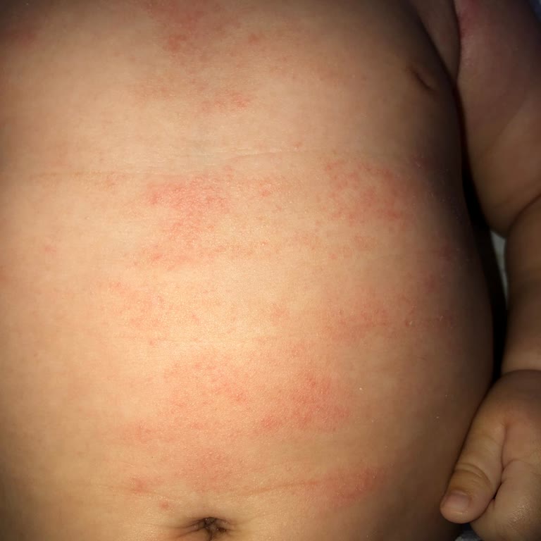 Bebek Şampuanı Ciltte Alerji Ve Tahrişe Sebep Oldu