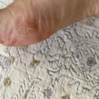 Ayakkabının Dikişi Ayağımı Yaraladı Değişim Talebim Reddedildi