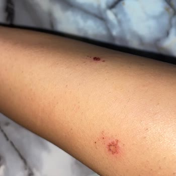 Lazer Epilasyon Sonrası Yanık Ve Şube Değişikliğinde Destek Eksikliği