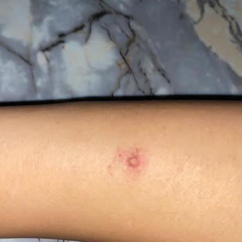 Lazer Epilasyon Sonrası Yanık Ve Şube Değişikliğinde Destek Eksikliği