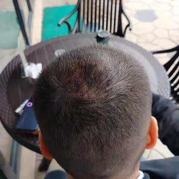 Saç Kapatıcı Ürün 2 Günde Çıktı, Tatilde Mağdur Oldum