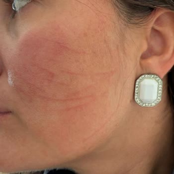 Glam Life Güzellik Merkezi İşlem Sert ve Özensiz Yapıldı